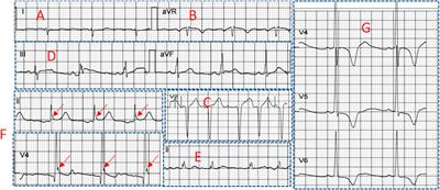 Electrocardiography is Useful to Predict Postoperative Ventricular Arrhythmia in Patients Undergoing Cardiac Surgery: A Retrospective Study